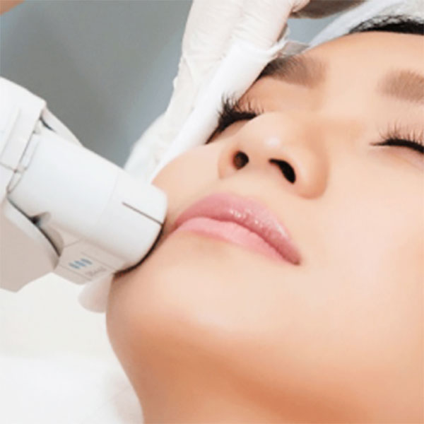 Triệt Lông Laser Lông Mép Cằm onerror=